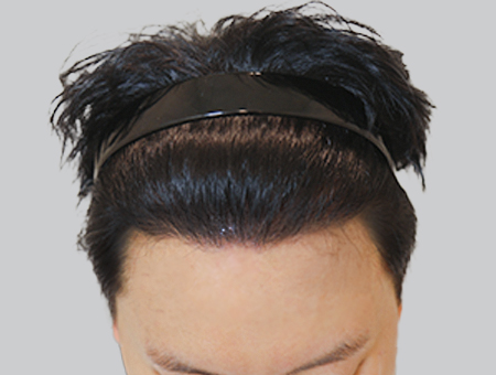 After 女性症例 ヘアライン 2025