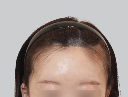 Before 女性症例 ヘアライン 2025