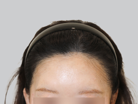 After 女性症例 ヘアライン 2025