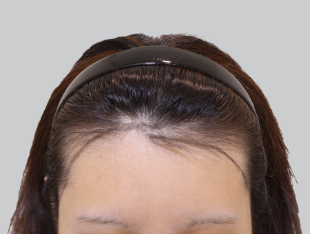 Before 女性症例 ヘアライン 2025