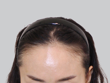 Before 女性症例 ヘアライン 2025