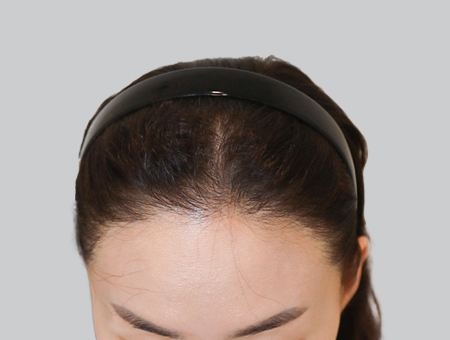 After 女性症例 ヘアライン 2025