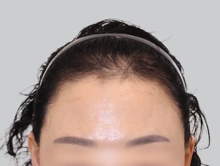 Before 女性症例 ヘアライン 2025