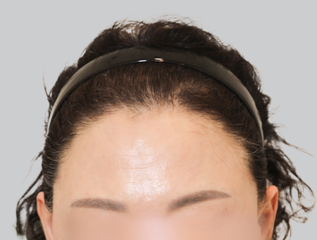 After 女性症例 ヘアライン 2025