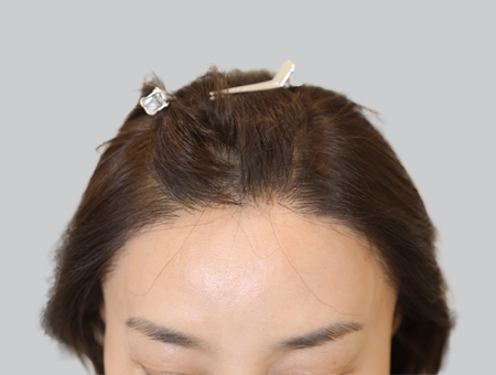 After 女性症例 ヘアライン 2025