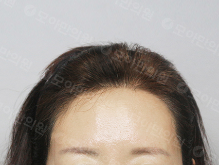 After 女性症例24 ヘアライン