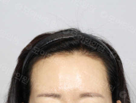 Before 女性症例24 ヘアライン