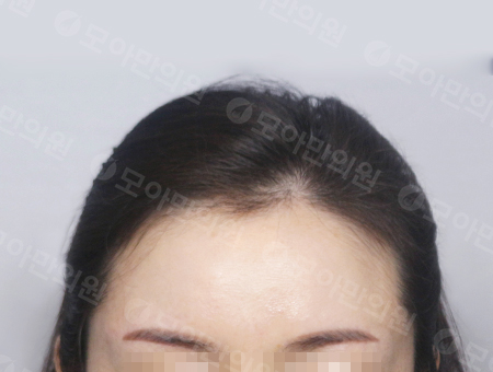 Before 女性症例23 ヘアライン