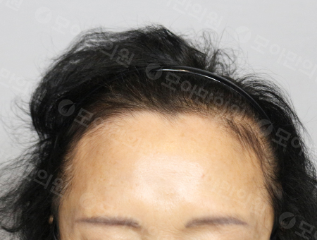 Before 女性症例22 ヘアライン