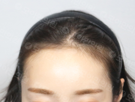 Before 女性症例19 ヘアライン