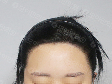 After 女性症例18 ヘアライン