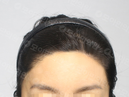 After 女性症例06 ヘアライン