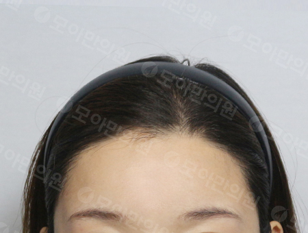 After 女性症例04 ヘアライン
