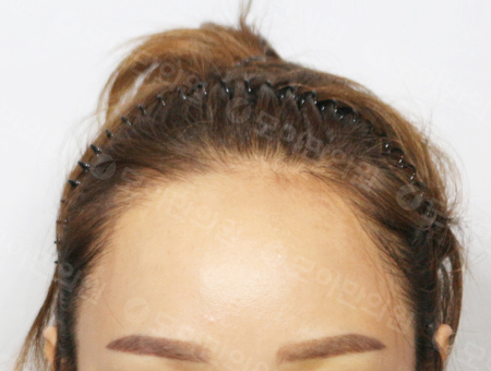 Before 女性症例25 ヘアライン