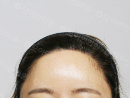 After 女性症例15 ヘアライン