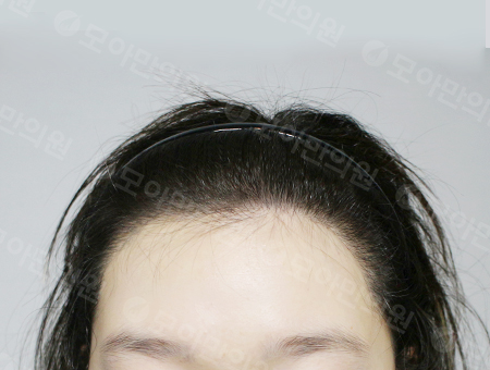 After 女性症例13 ヘアライン