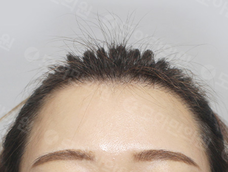 After 女性症例16 ヘアライン