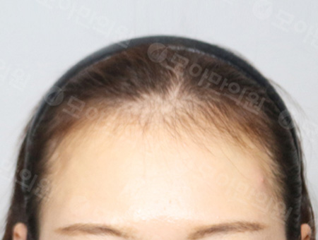 Before 女性症例16 ヘアライン