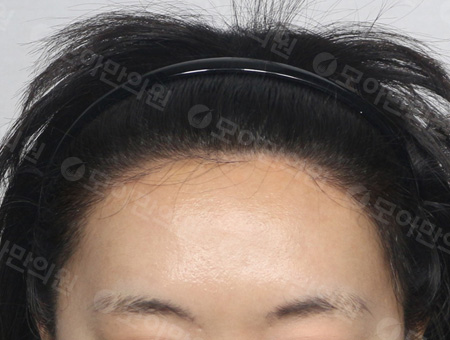 Before 女性症例11 ヘアライン