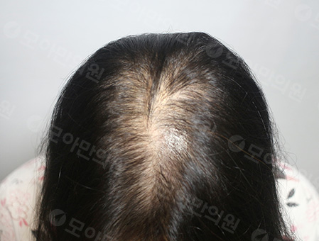 Before 女性症例01 頭頂部